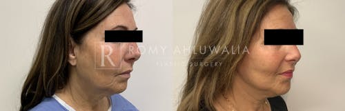 Before & After Result of Mini Facelift Patient #27