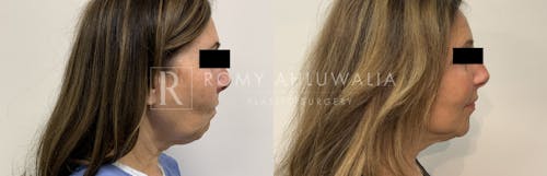 Before & After Result of Mini Facelift Patient #27