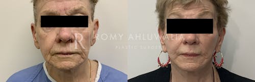 Before & After Result of Mini Facelift Patient #28