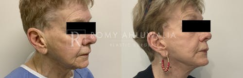 Before & After Result of Mini Facelift Patient #28