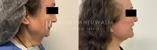 Before & After Result of Facelift Patient #29