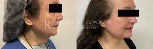 Before & After Result of Facelift Patient #29