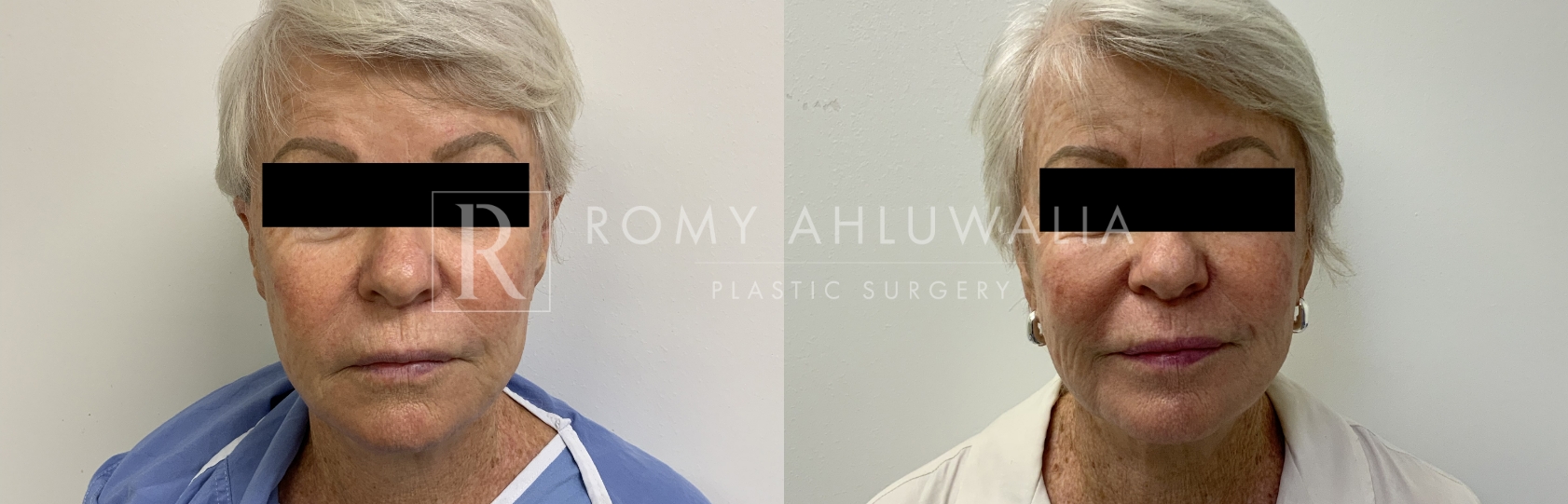 NanoGlow Facial Before and After