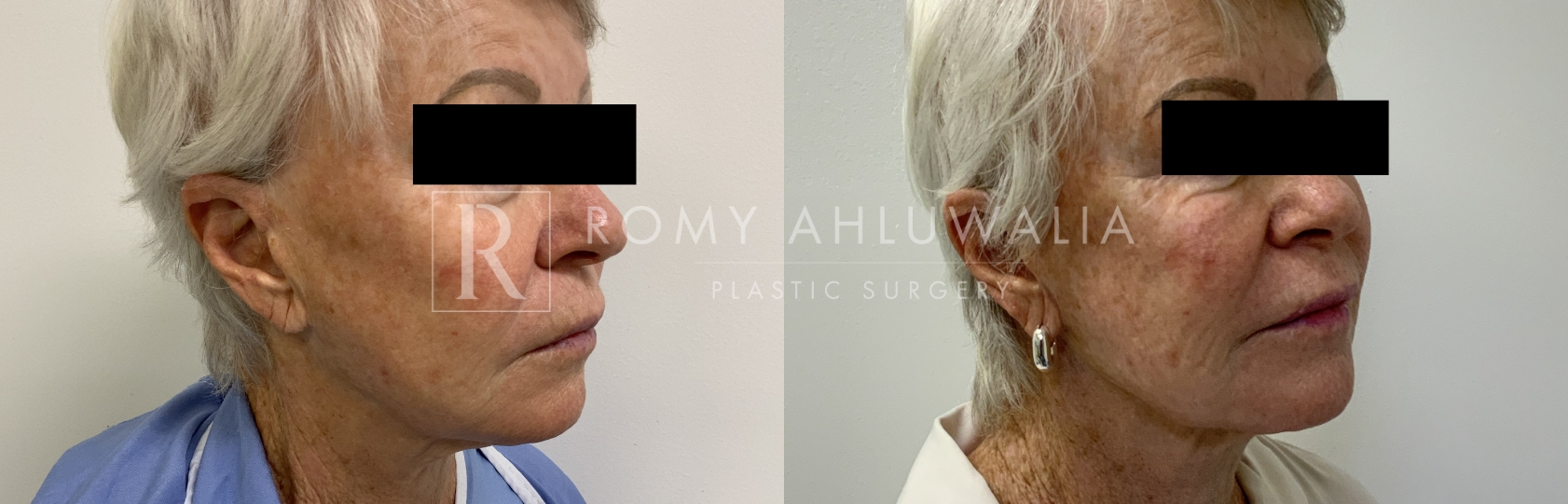 NanoGlow Facial Before and After