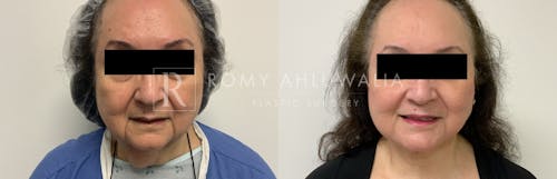 Before & After Result of Facelift Patient #29