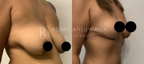 Before & After Result of Breast Reduction Patient #43