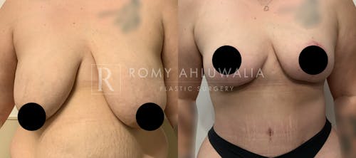 Before & After Result of Breast Reduction Patient #44