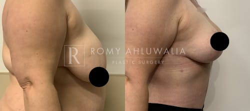 Before & After Result of Breast Reduction Patient #44
