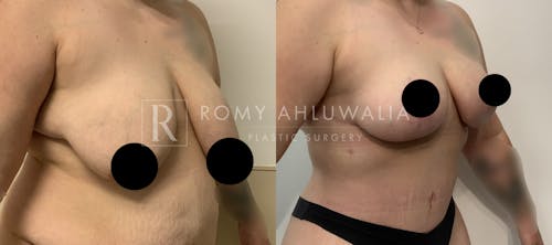 Before & After Result of Breast Reduction Patient #44