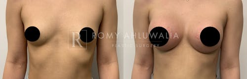 Before & After Result of Breast Augmentation Patient #23