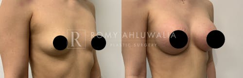 Before & After Result of Breast Augmentation Patient #23