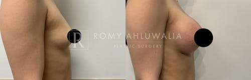 Before & After Result of Breast Augmentation Patient #23
