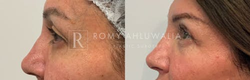 Before & After Result of Upper Eyelid Surgery Patient #20