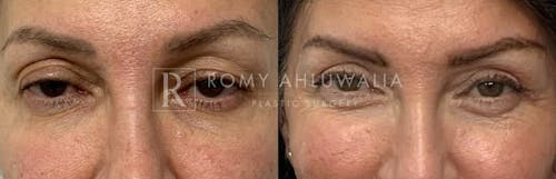 Before & After Result of Upper Eyelid Surgery Patient #20