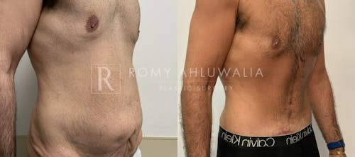 Before & After Result of Tummy Tuck Patient #89