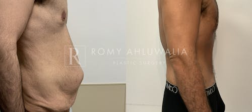 Before & After Result of Tummy Tuck Patient #89