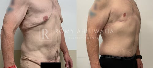 Before & After Result of Tummy Tuck Patient #88