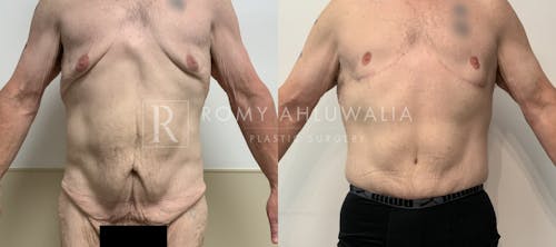 Before & After Result of Tummy Tuck Patient #88