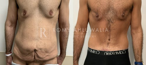 Before & After Result of Tummy Tuck Patient #89