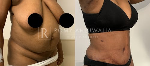 Before & After Result of Tummy Tuck Patient #94