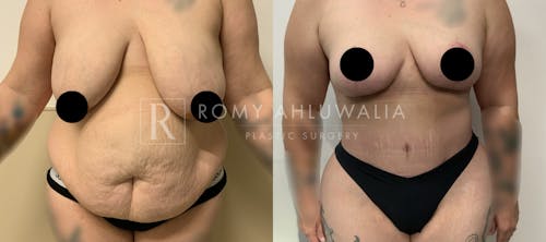 Before & After Result of Tummy Tuck Patient #93