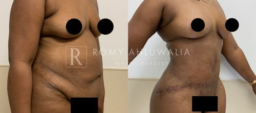 Before & After Result of Tummy Tuck Patient #90