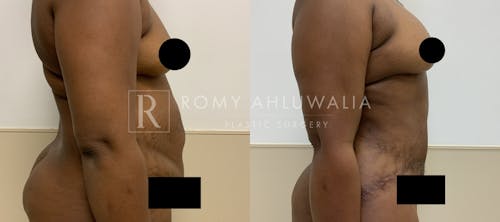 Before & After Result of Tummy Tuck Patient #90