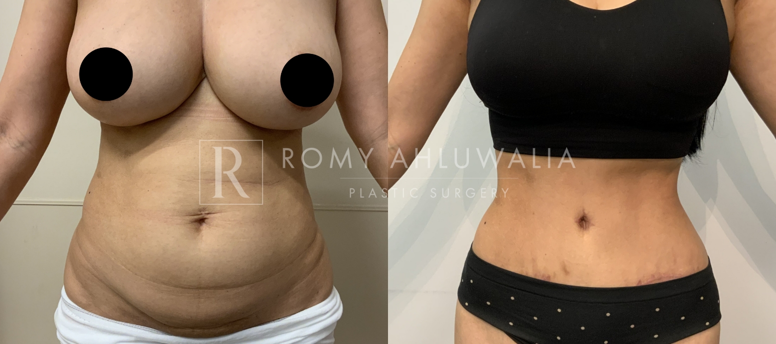 NanoSculpt Before and After