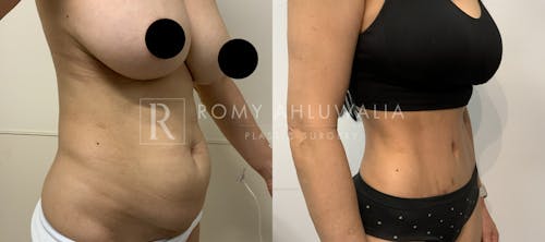 Before & After Result of Tummy Tuck Patient #91