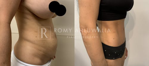 Before & After Result of Tummy Tuck Patient #91
