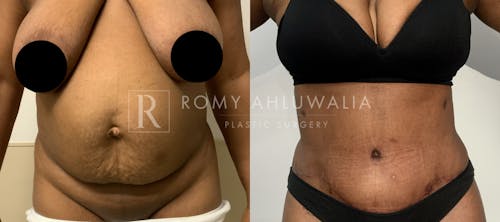 Before & After Result of Tummy Tuck Patient #94