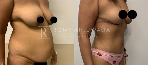 Before & After Result of Tummy Tuck Patient #92