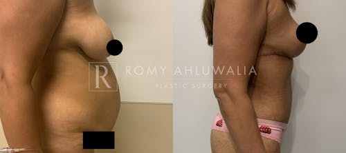Before & After Result of Tummy Tuck Patient #92