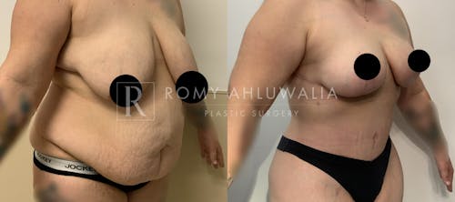 Before & After Result of Tummy Tuck Patient #93