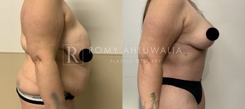 Before & After Result of Tummy Tuck Patient #93