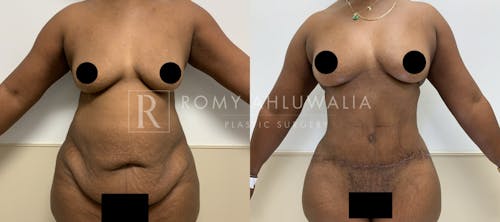 Before & After Result of Tummy Tuck Patient #90