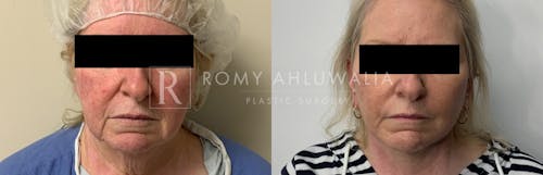 Before & After Result of Facelift Patient #26