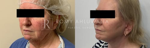 Before & After Result of Facelift Patient #26
