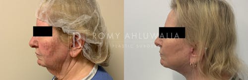 Before & After Result of Facelift Patient #26