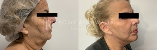 Before & After Result of Facelift Patient #24