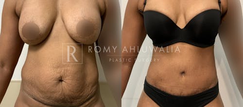 Before & After Result of Tummy Tuck Patient #2