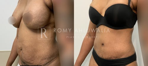Before & After Result of Tummy Tuck Patient #2