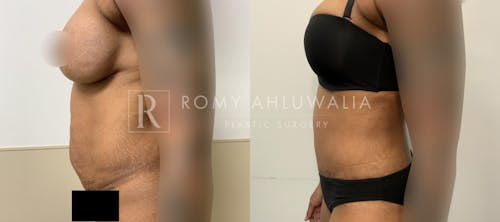 Before & After Result of Tummy Tuck Patient #2