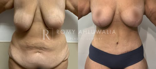 Before & After Result of Tummy Tuck Patient #3