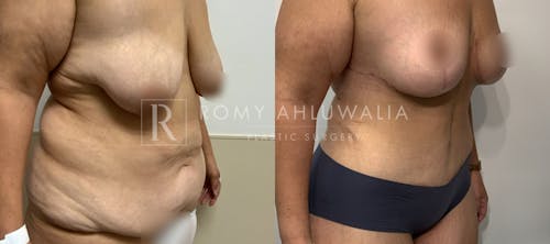 Before & After Result of Tummy Tuck Patient #3