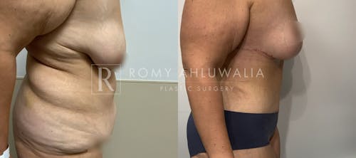 Before & After Result of Tummy Tuck Patient #3