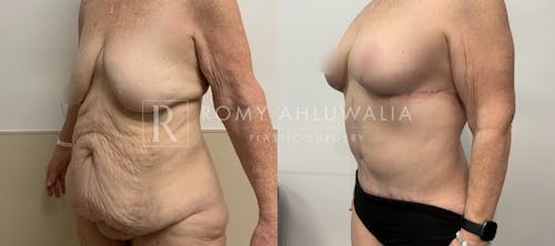 Before & After Result of Tummy Tuck Patient #99