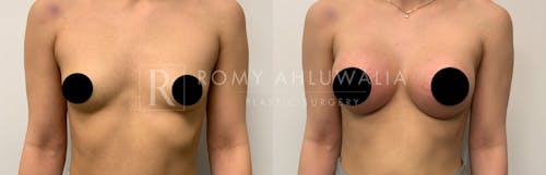 Before & After Result of Breast Augmentation Patient #1