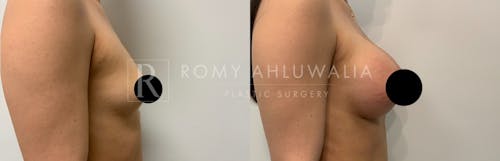 Before & After Result of Breast Augmentation Patient #1