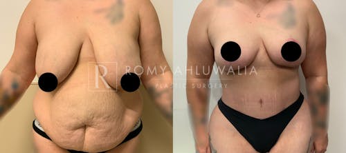 Before & After Result of Tummy Tuck Patient #100